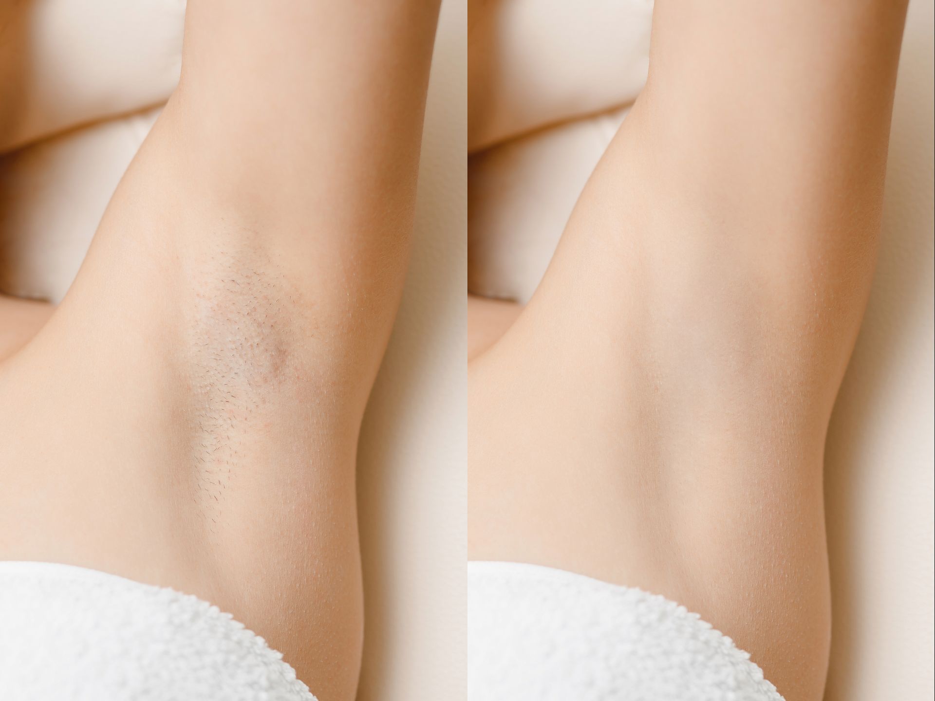 A before and after photo of a woman 's underarm.