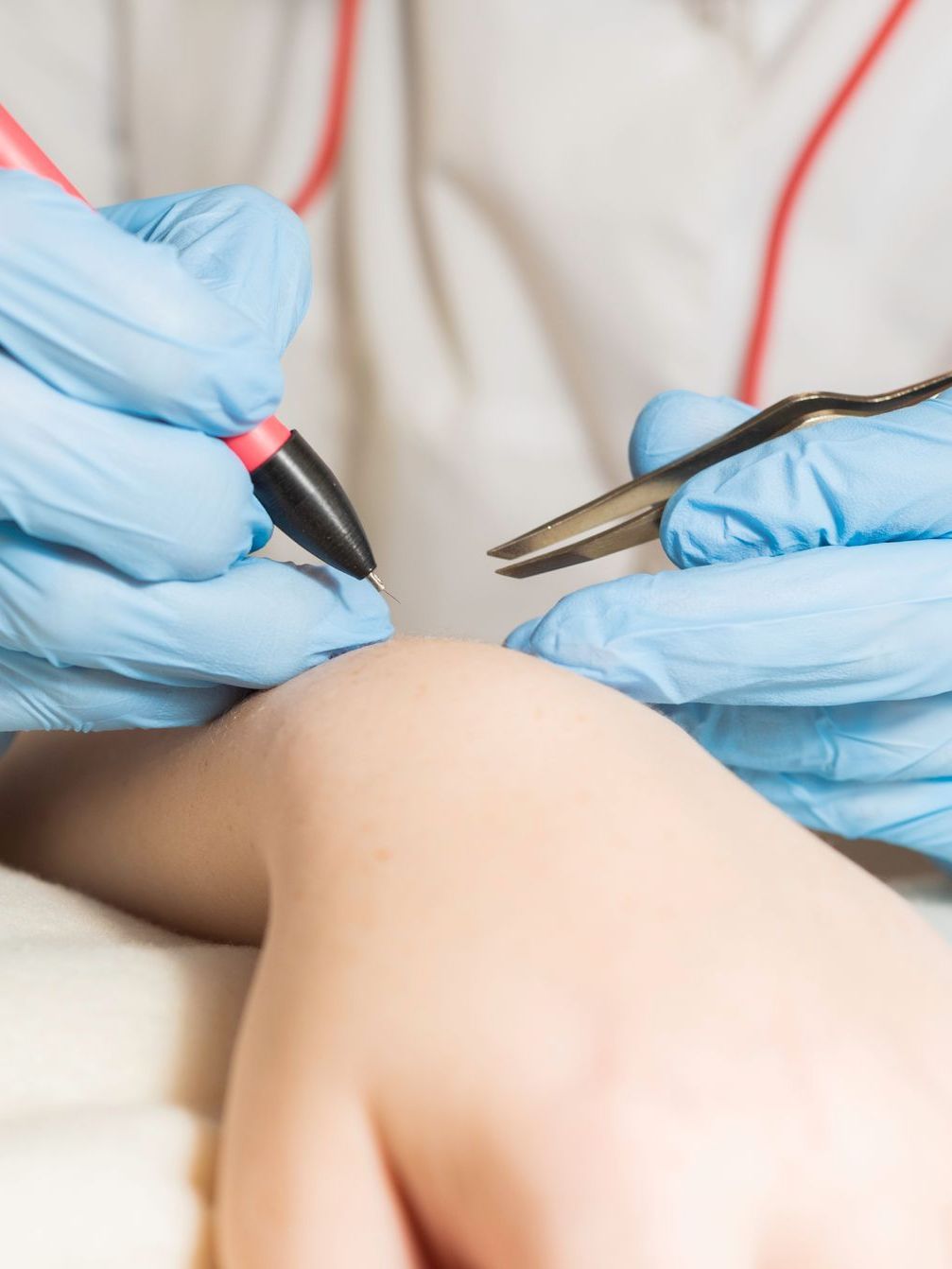 A doctor is writing on a patient 's wrist with a pen and tweezers.