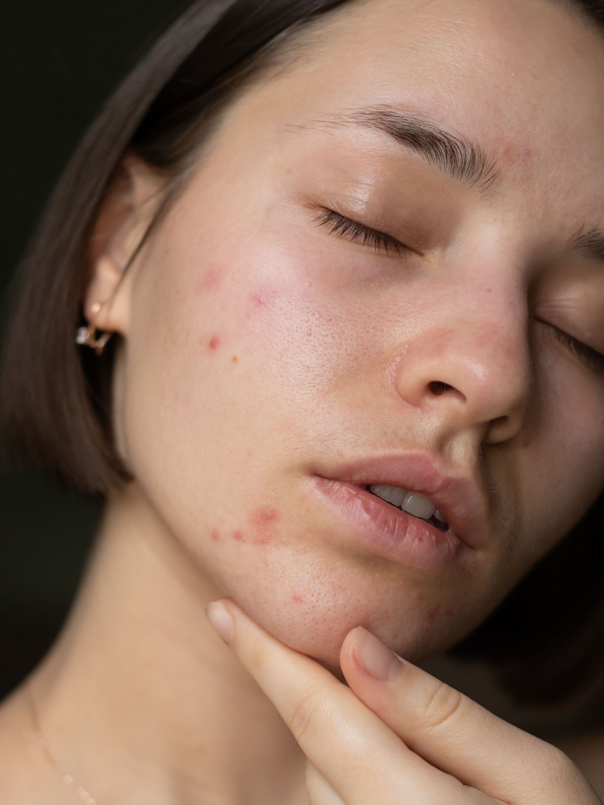 A woman with acne on her face is touching her face with her hand.