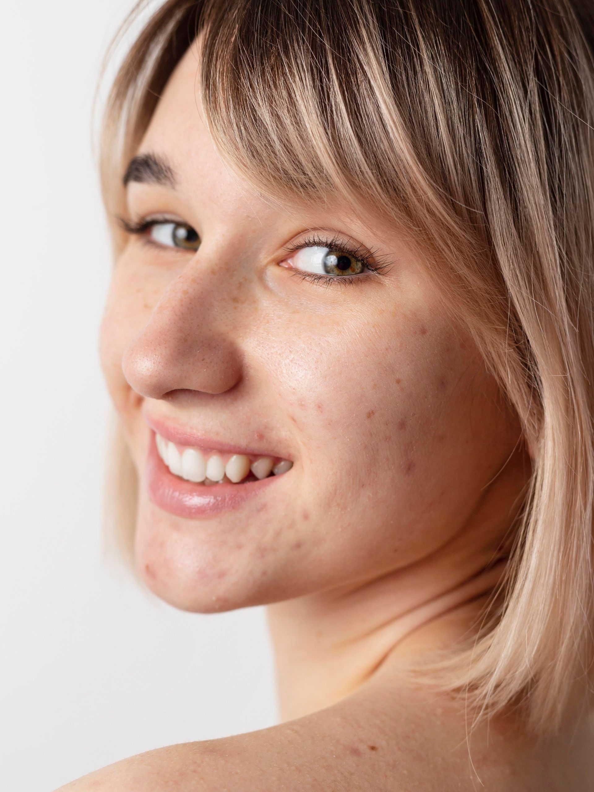 A woman with acne on her face is smiling and looking over her shoulder.