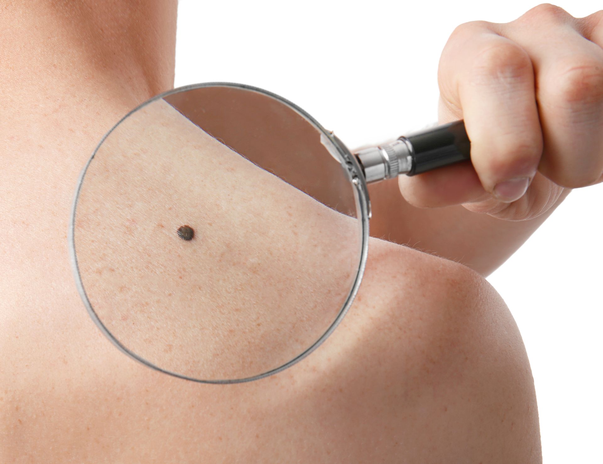 A person is looking at a small black spot on their back with a magnifying glass