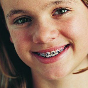 fixed braces treatment