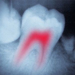Endodontics treatment