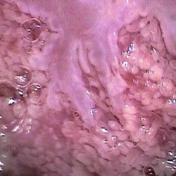 Microcolposcopia