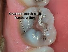 A close up of a cracked tooth with a fracture line.