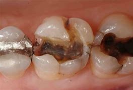 A close up of a person 's teeth with a lot of holes in them.