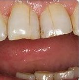 A close up of a person 's teeth and mouth.