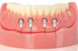 A model of a denture with three dental implants in it.