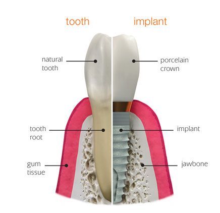 A diagram showing the difference between a tooth and an implant