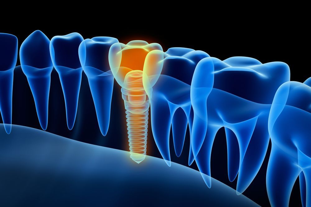 X-ray showing a dental implant in the jawbone, highlighted in yellow.