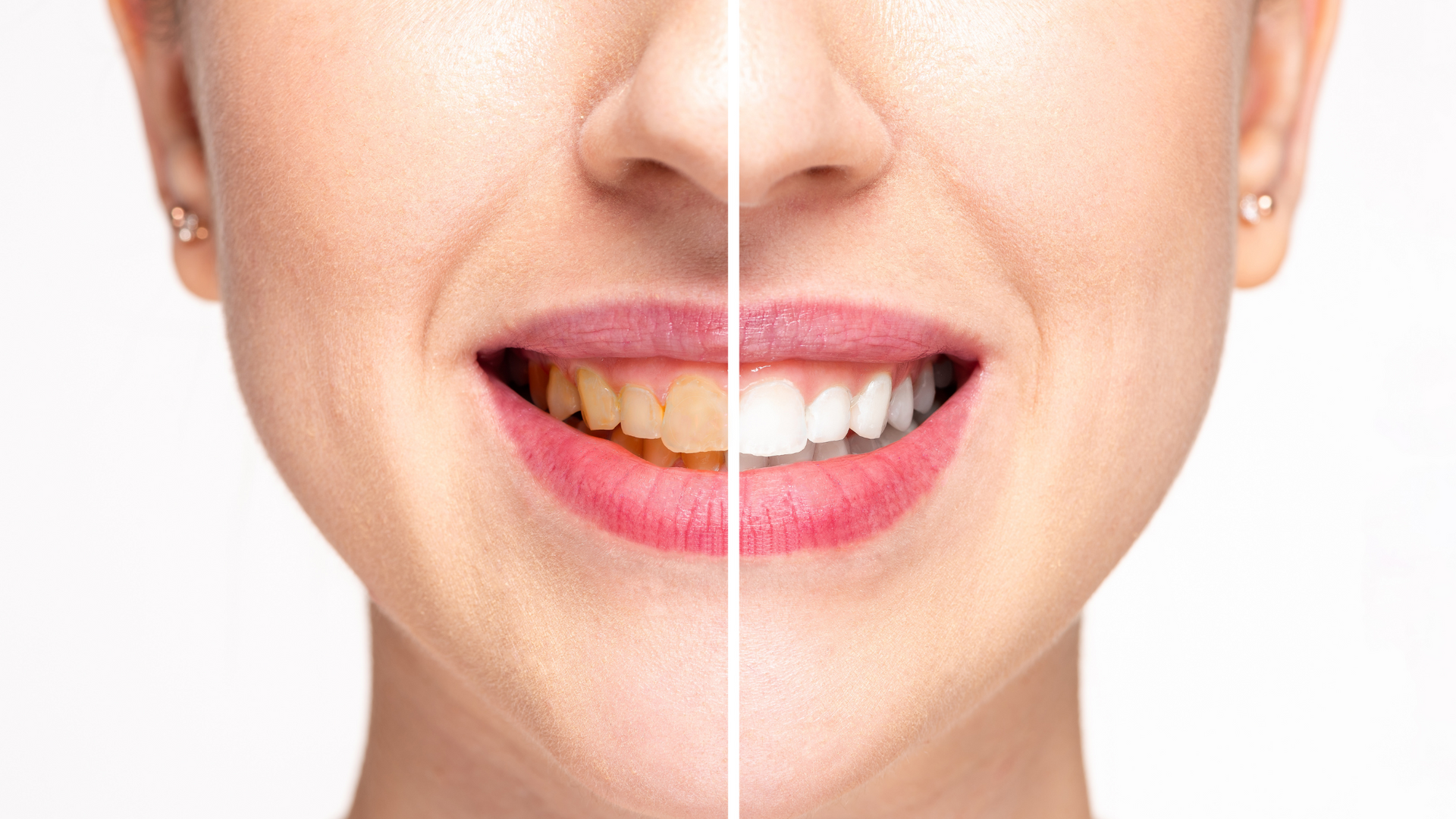 Woman's smile, showing comparison of yellow teeth (left) and whitened teeth (right) for cosmetic effect.