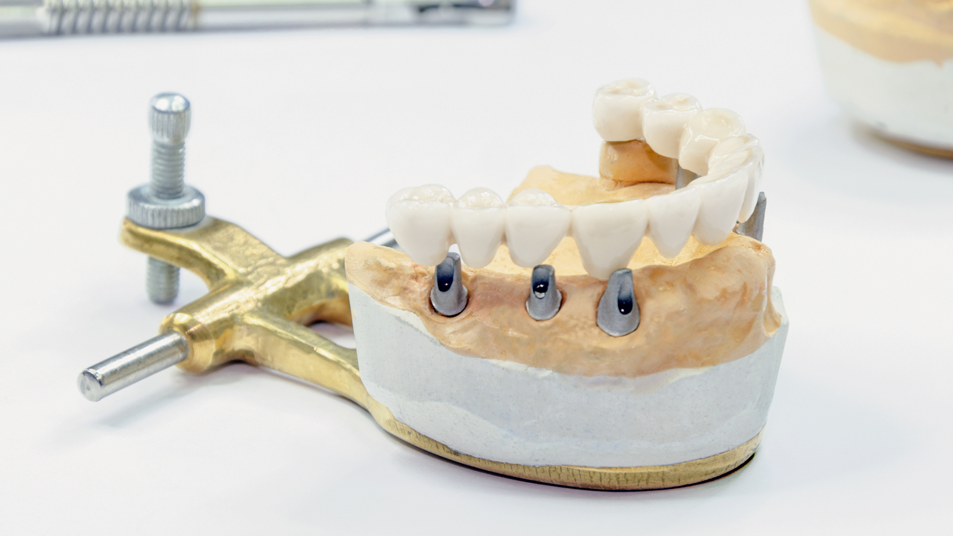 Dental implant model with three artificial teeth, cream-colored teeth and gums, on a white surface.