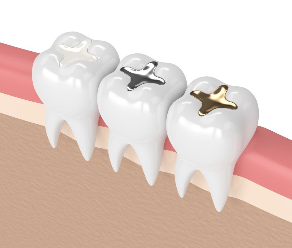 Three teeth with different colored fillings: white, silver, and gold.
