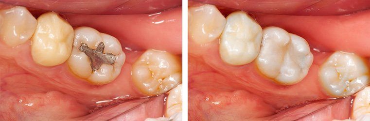 tooth-colored fillings