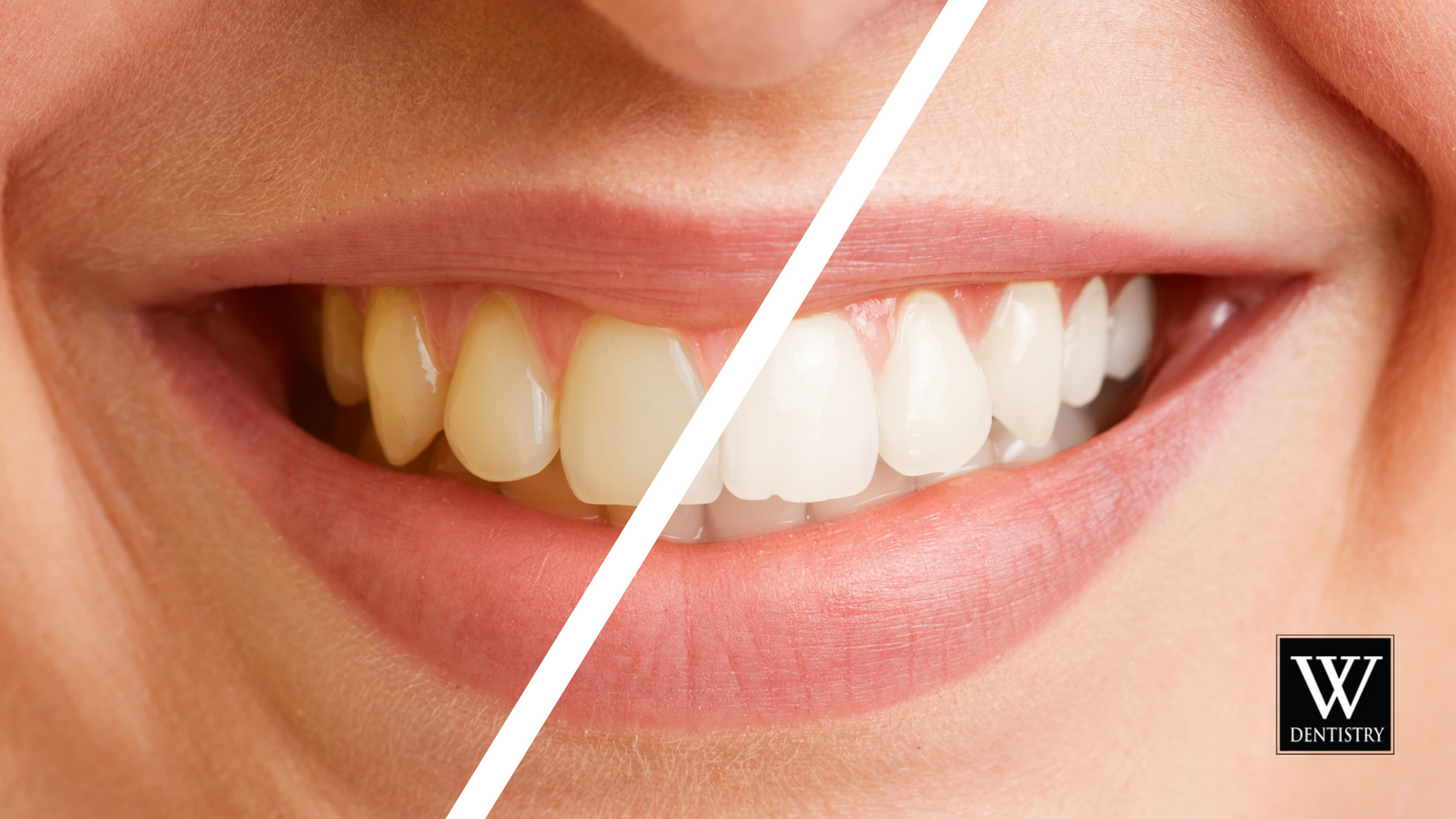 A close up of a woman 's teeth before and after whitening.