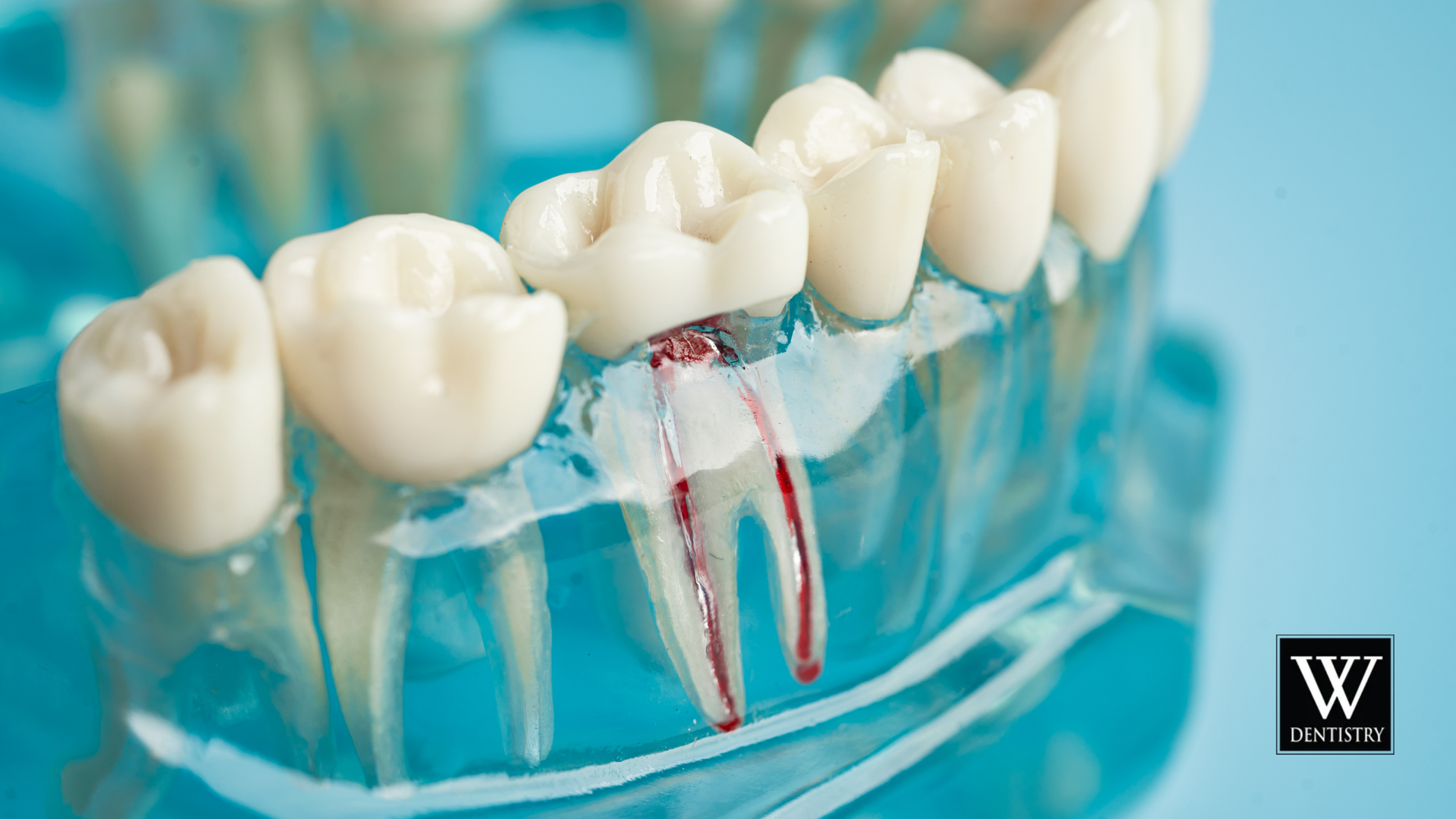 Dental model showing a tooth with root canals, red lines inside clear roots, against a blue background.