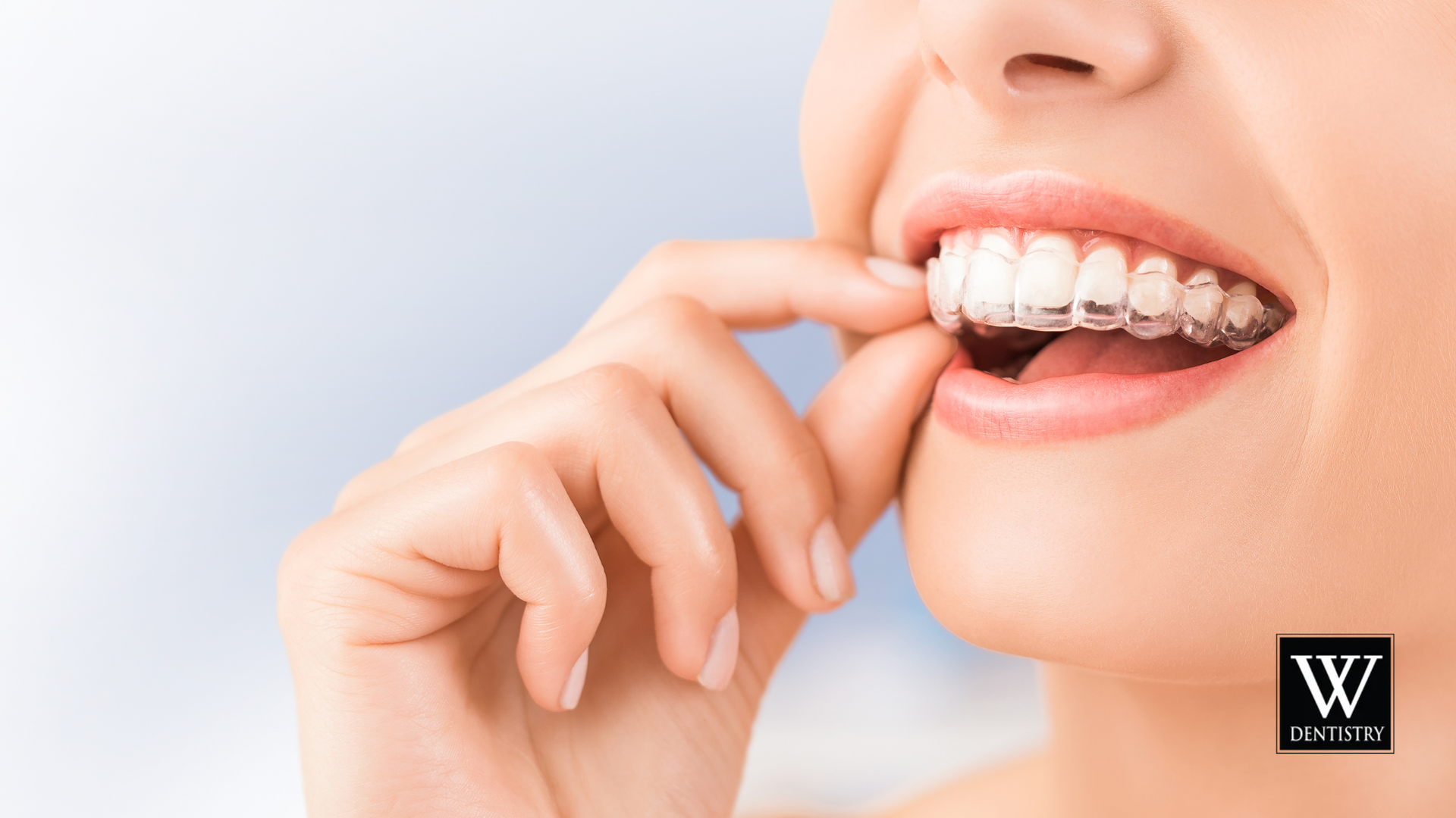 Woman smiling, putting in clear aligner, dental health concept.