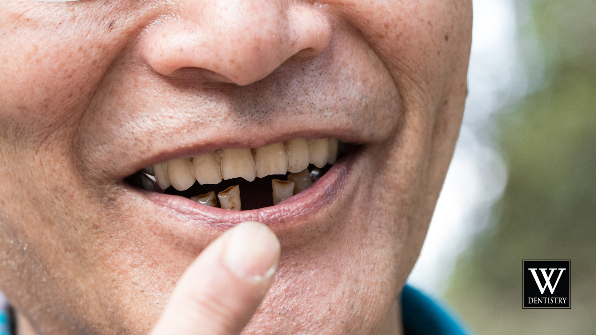 Close-up of a man with missing lower front teeth smiling. A finger points at the gap.