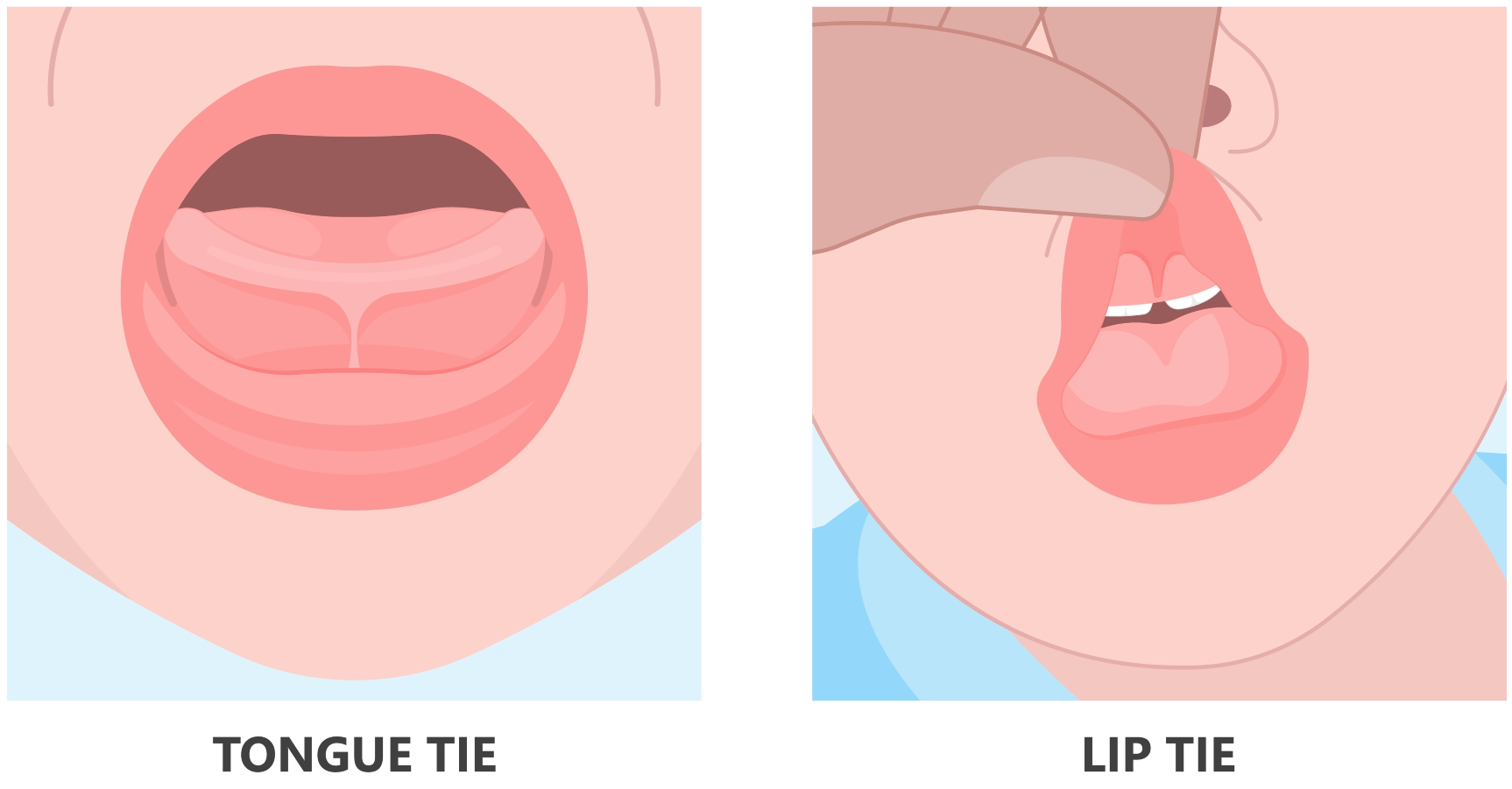 Frenectomy In Newmarket Tongue Tie And Lip Tie