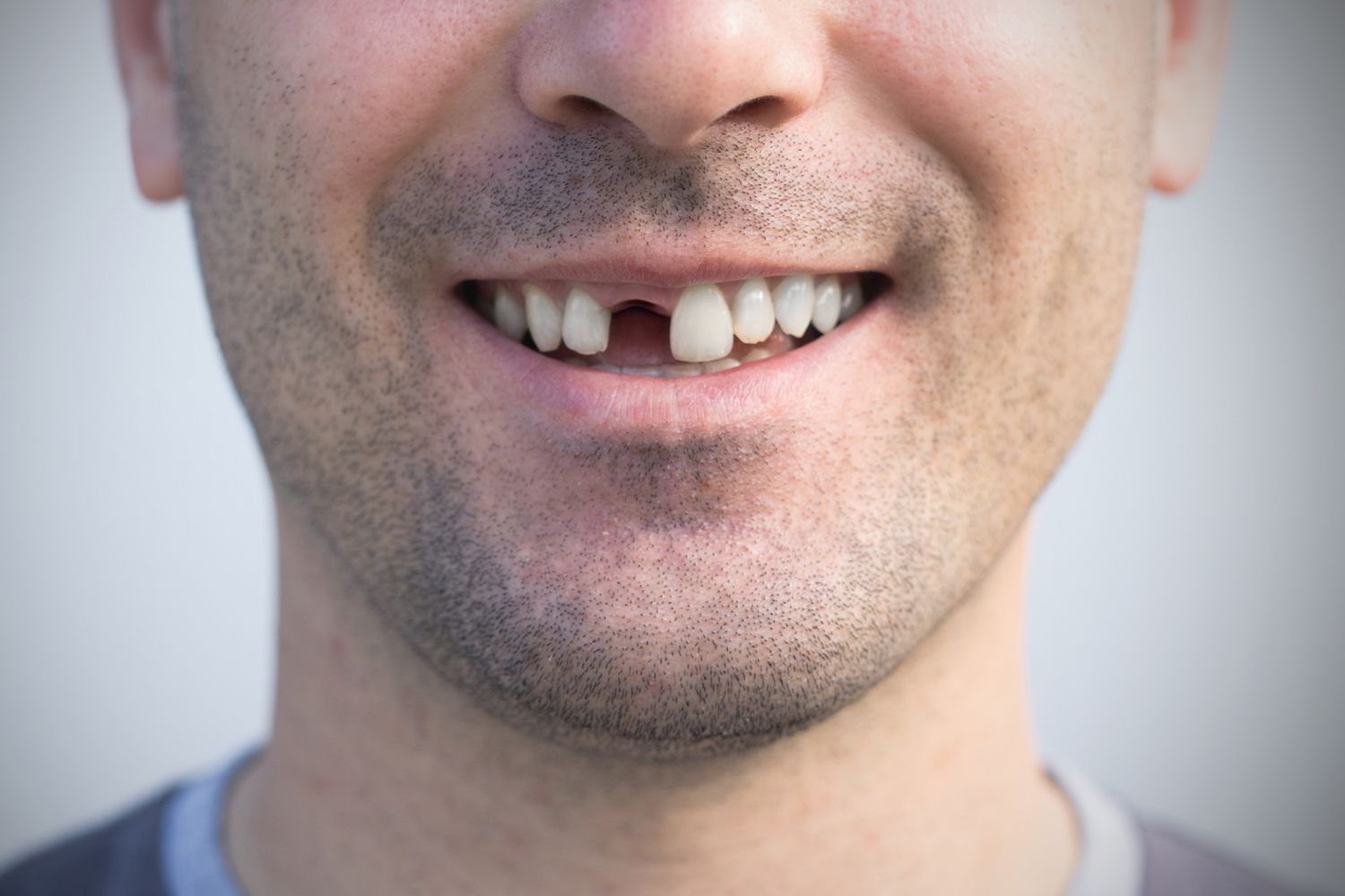 Close-up of a smiling mouth with a missing front tooth