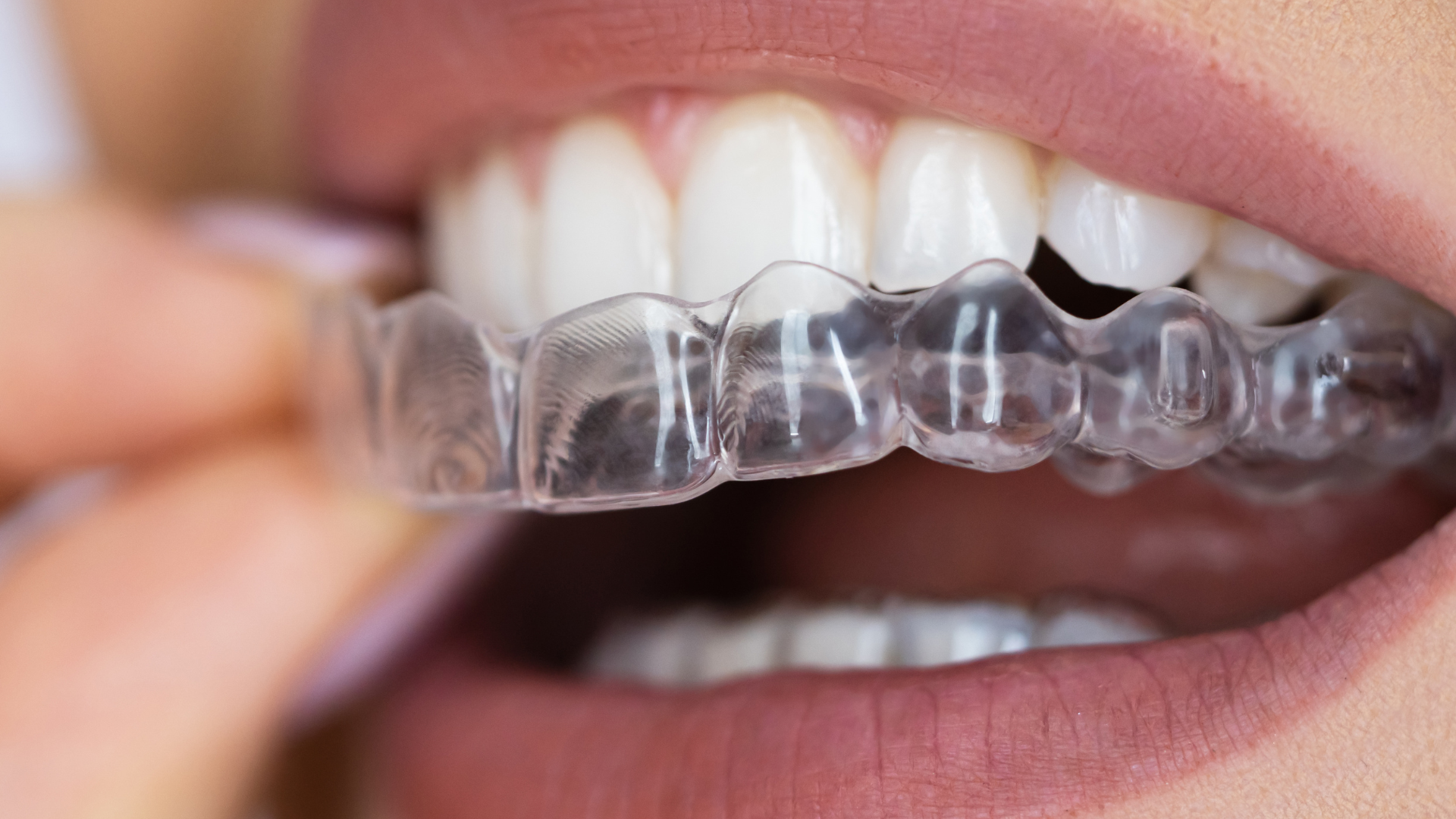 SureSmile® Clear Braces vs. Invisalign: Which Is the Better Choice for Your Smile?