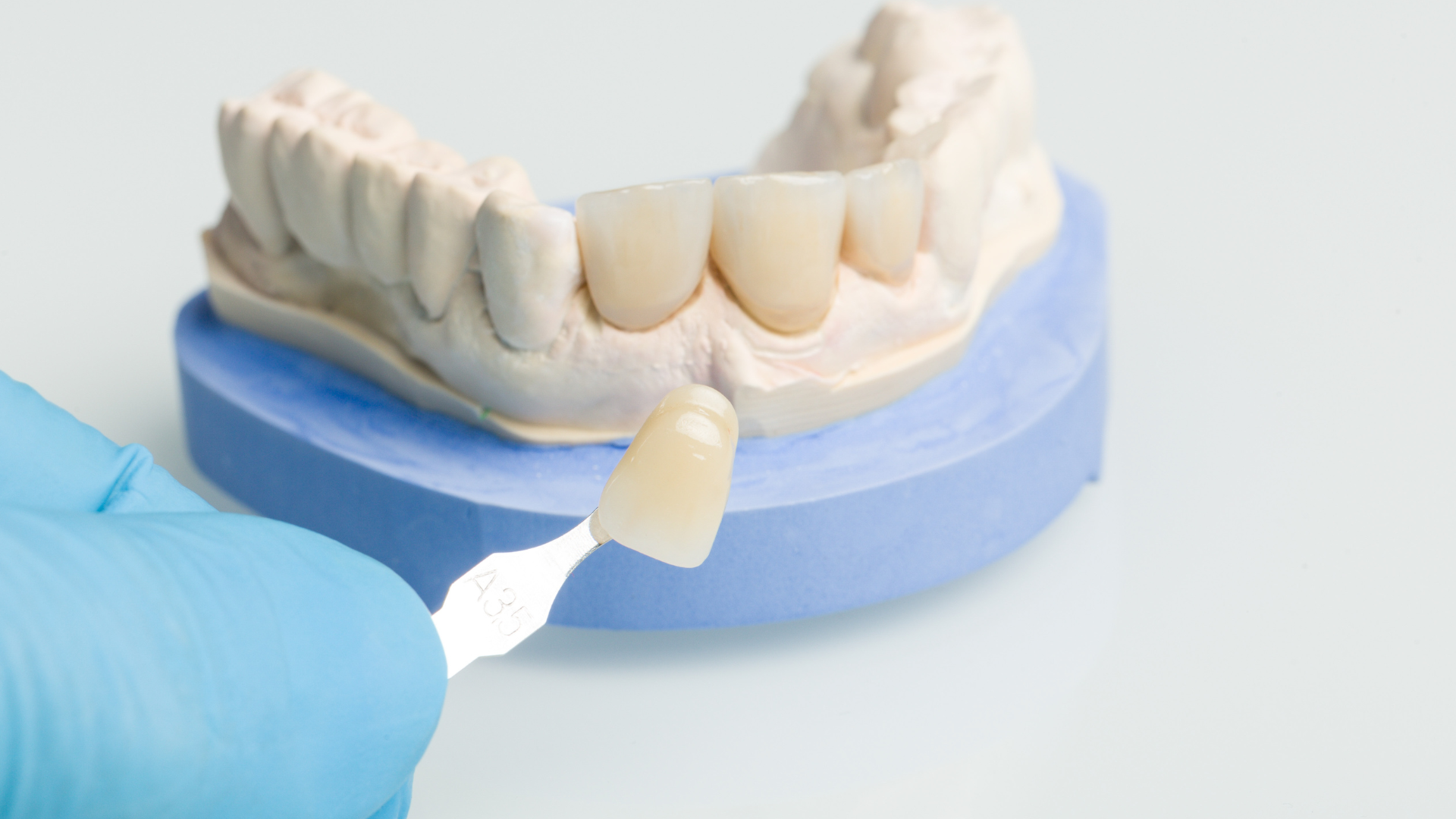 Getting Veneers Abroad vs. Locally: What Are the Risks and Benefits?