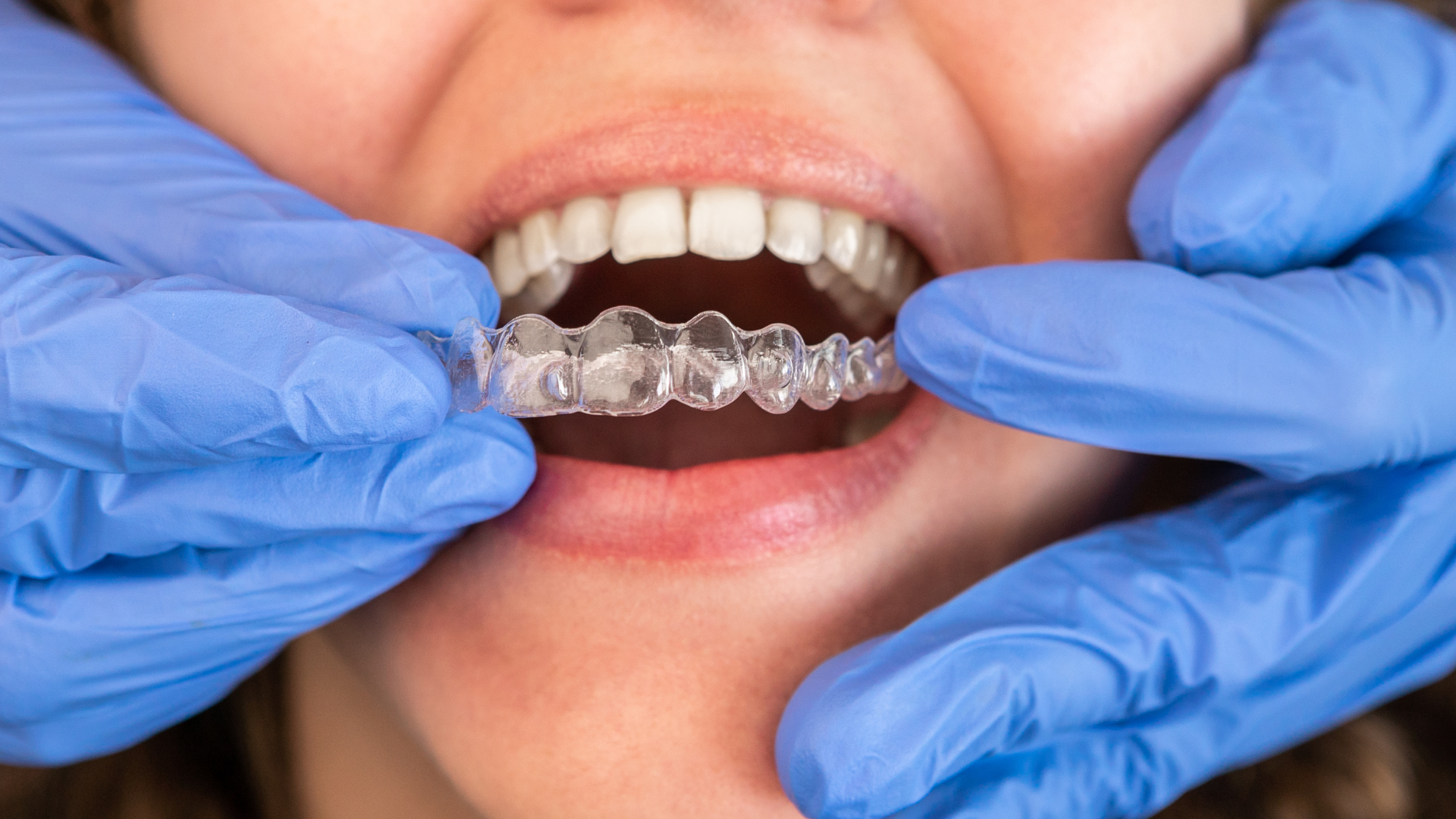 How Invisalign Affects Speech and Comfort During the First Week
