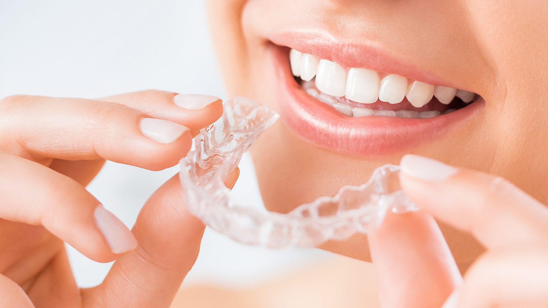How SureSmile® Clear Braces Work: A Complete Guide for First-Time Patients