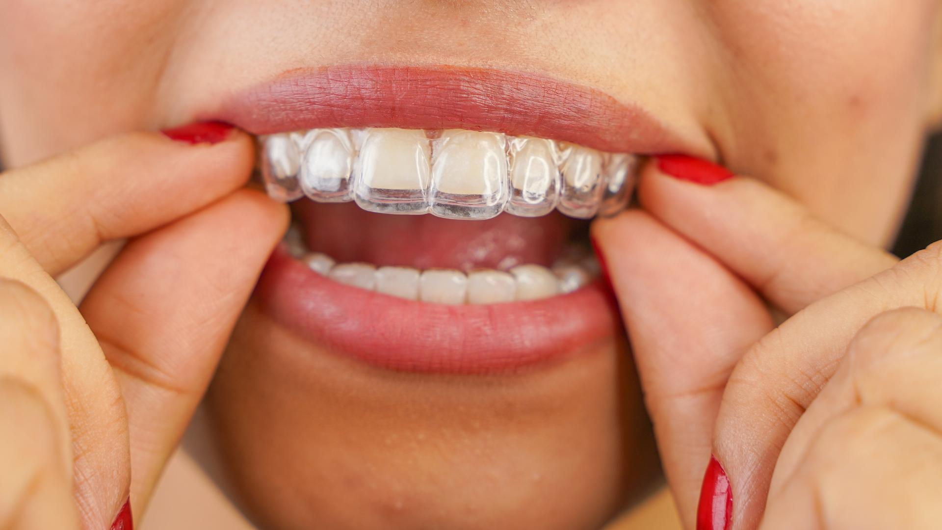 What Can You Eat with Invisalign? A Guide for Clear Aligner Users