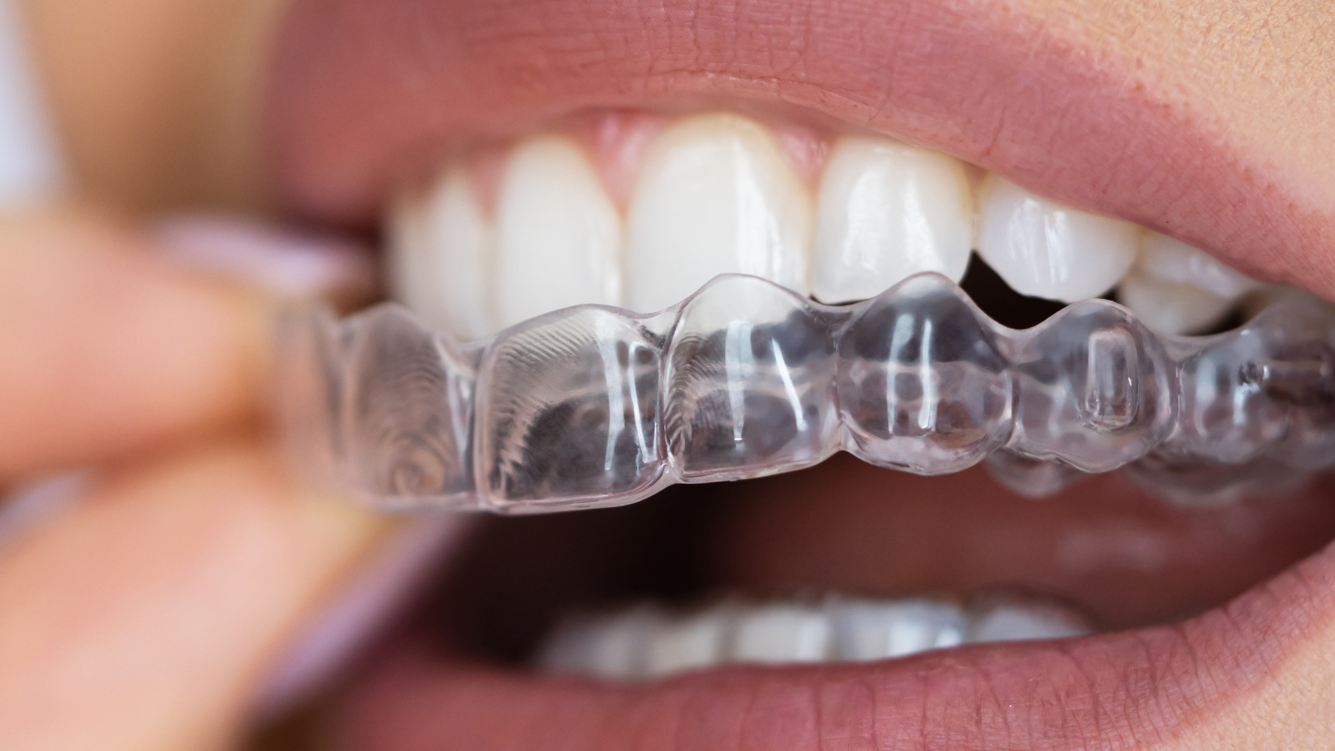 What Is the Difference Between SureSmile® and Other Clear Aligners?