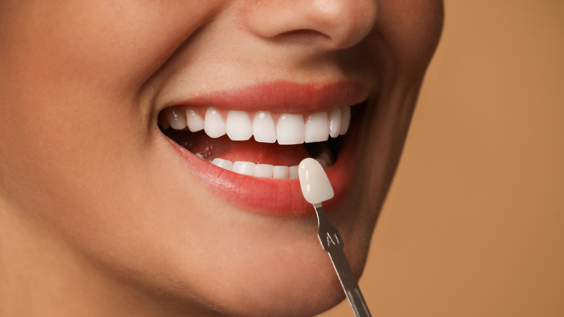 How Natural Do Veneers Actually Look in Real Life?