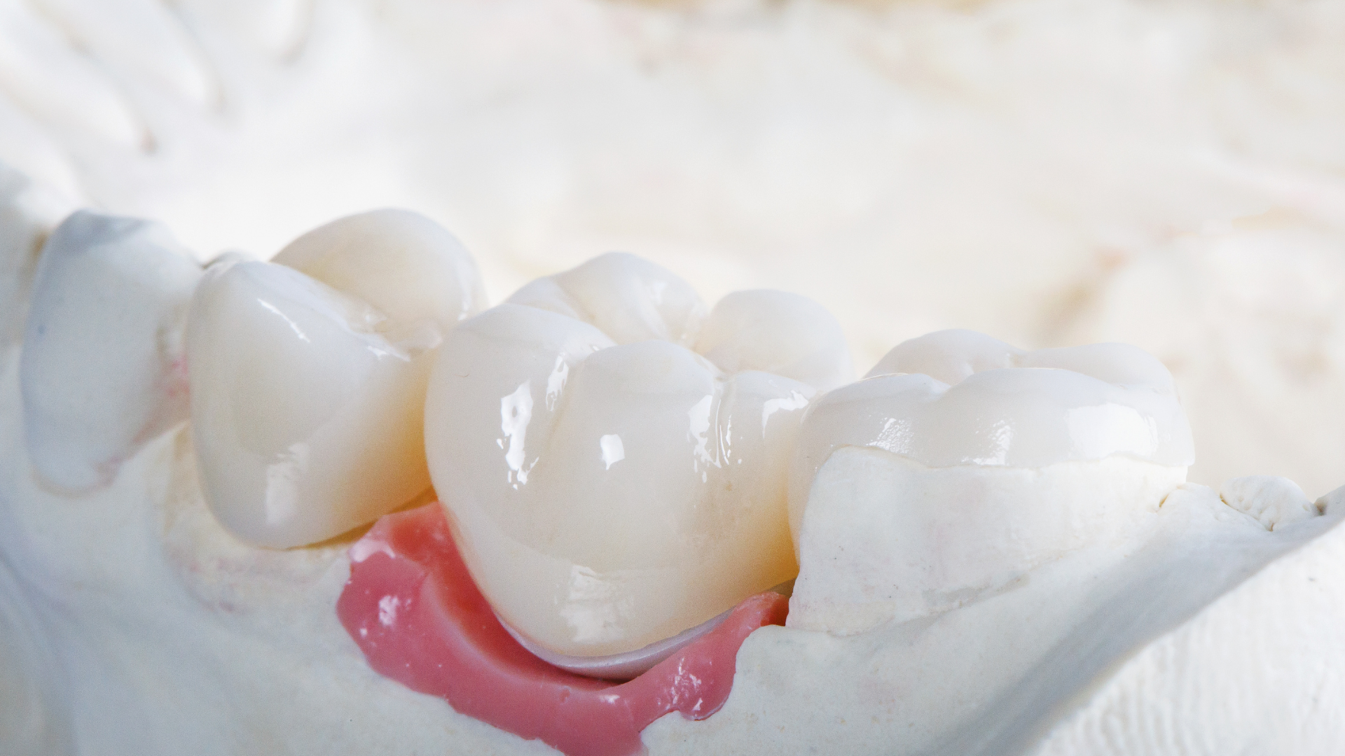 Lost a Filling or Crown? Here’s What to Do Before You See a Dentist