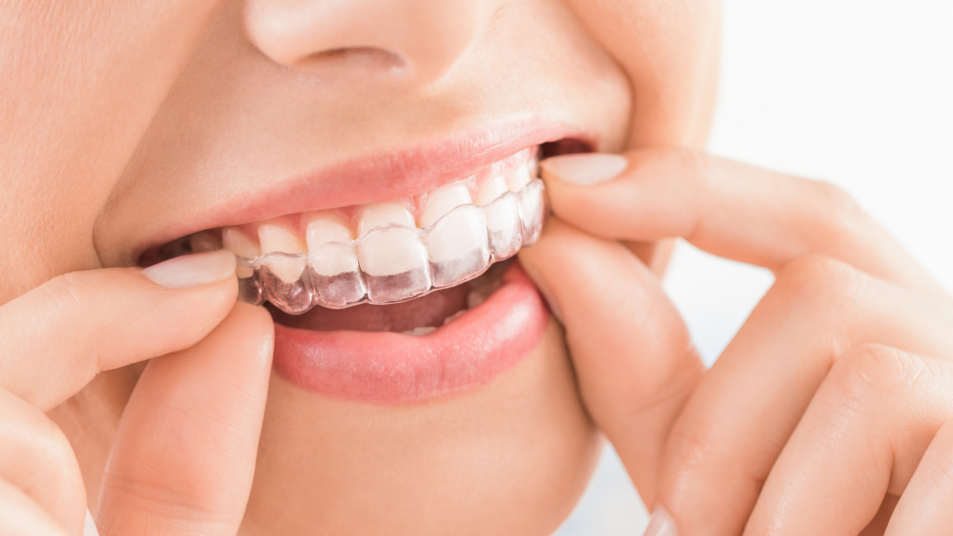 10 Reasons Why Invisalign Is the Clear Choice for Straightening Your Smile