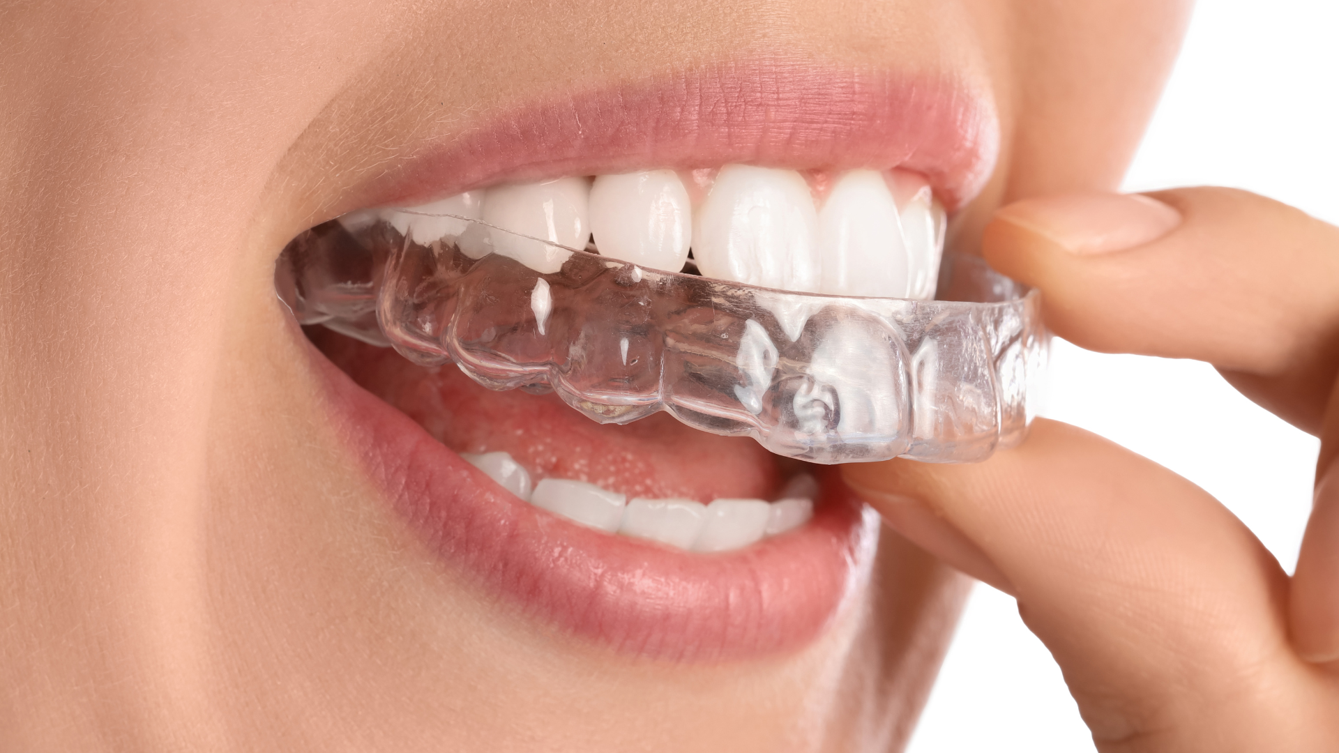 How Long Do SureSmile® Clear Braces Take to Straighten Teeth?