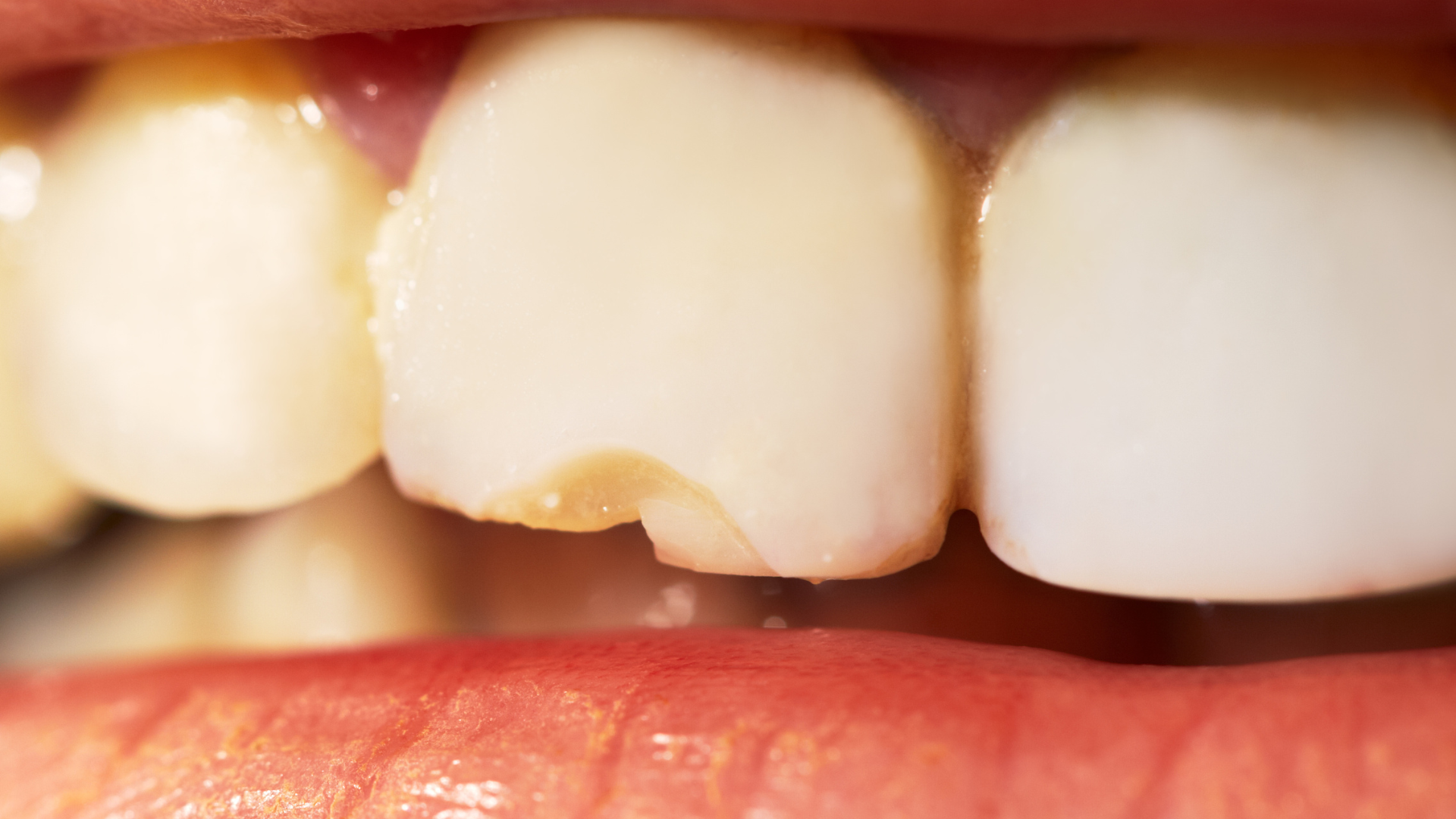Is a Cracked Tooth an Emergency? What You Need to Know