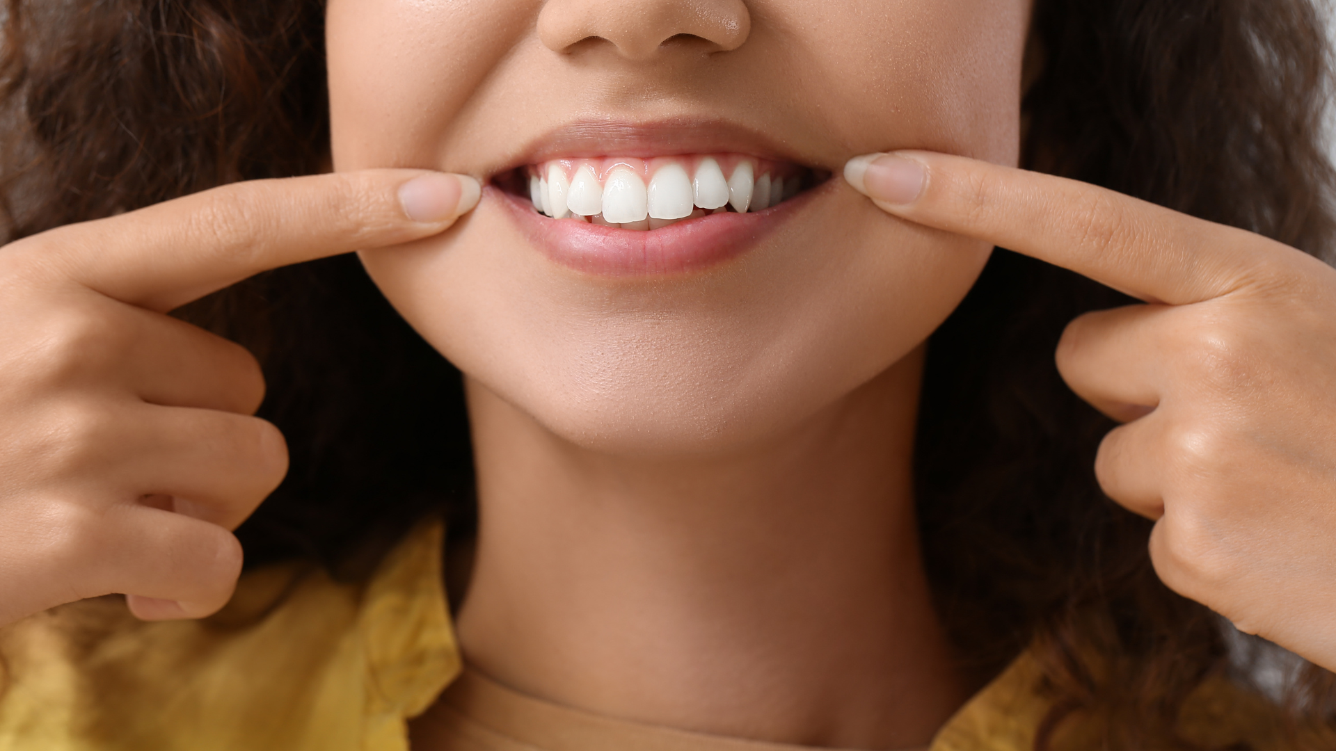 Can You Whiten Veneers? The Truth About Brightening Your Smile