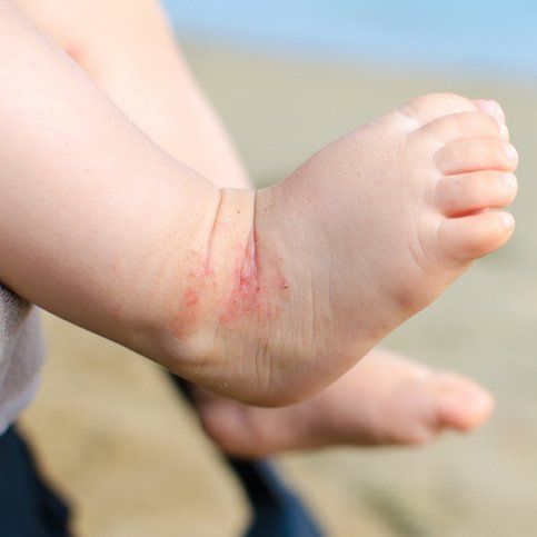 baby skin with eczema