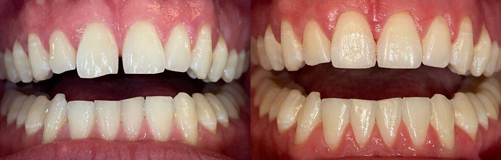 Invisalign Before & After 11