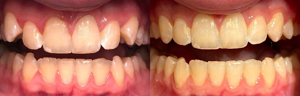 Invisalign Before & After 12