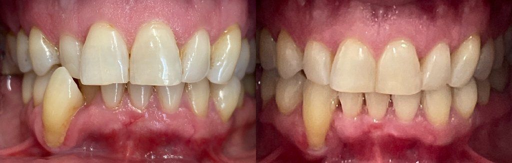 Invisalign Before & After 1