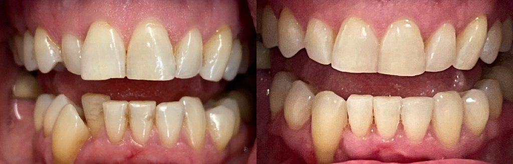Invisalign Before & After 2