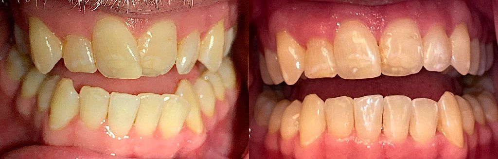 Invisalign Before & After 3