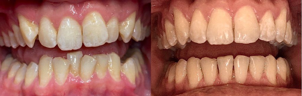 Invisalign Before & After 4