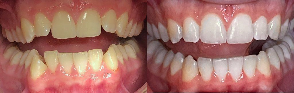 Invisalign Before & After 5