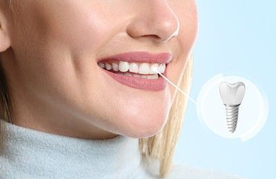 Dental Implant Osseointegration & Abutment Placement