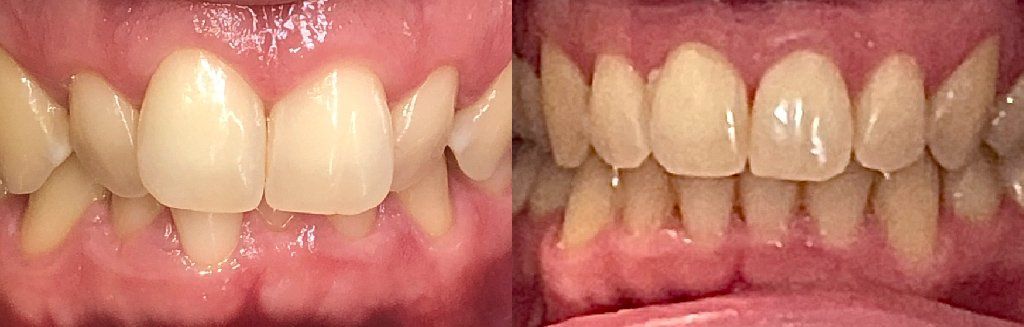 Invisalign Before & After 6