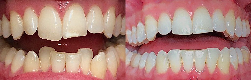 Invisalign Before & After 7