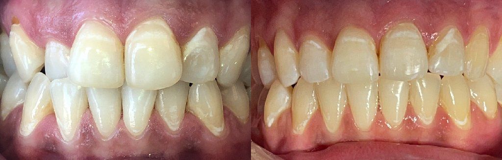 Invisalign Before & After 8