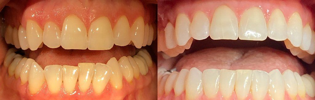 Invisalign Before & After 9