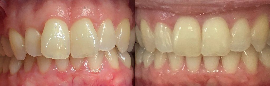 Invisalign Before & After 10
